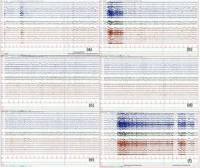 Case report: An EEG captured case of migralepsy/migraine aura-triggered seizures